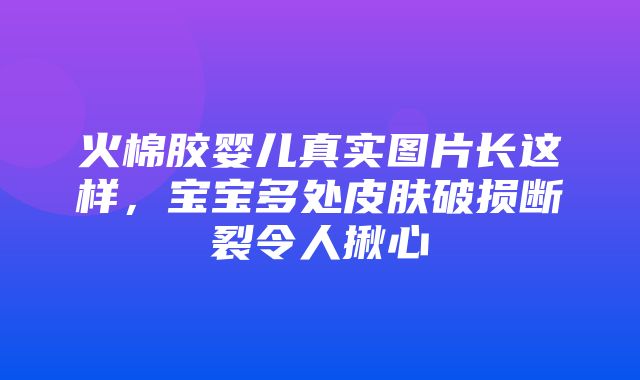 火棉胶婴儿真实图片长这样，宝宝多处皮肤破损断裂令人揪心