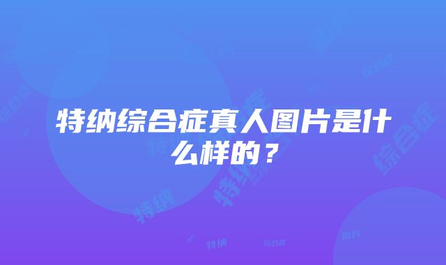 特纳综合症真人图片是什么样的？