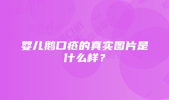 婴儿鹅口疮的真实图片是什么样？