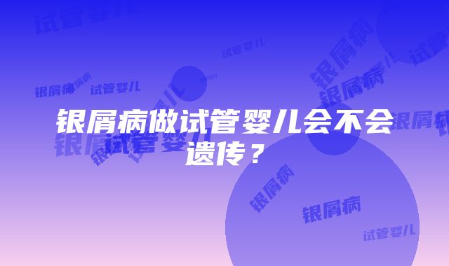 银屑病做试管婴儿会不会遗传？