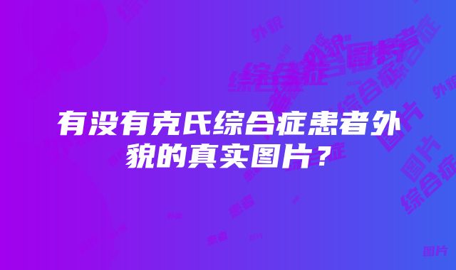 有没有克氏综合症患者外貌的真实图片？